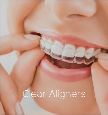 Clear aligners