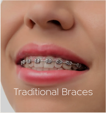 Traditional braces