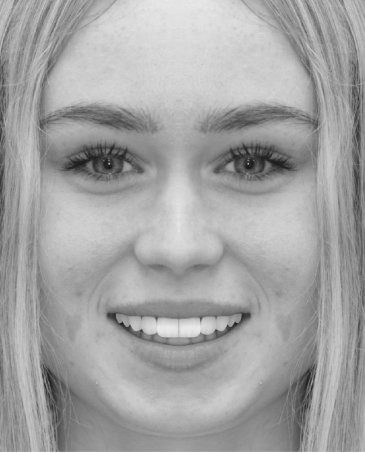 After orthodontic treatment